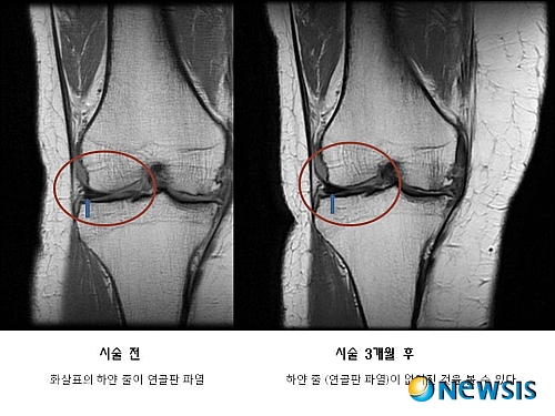 【서울=뉴시스】유상우 기자 = 무리한 운동이나 하이힐 등으로 무릎 반월상 연골판 파열 질환이 흔해지고 있다.&nbsp; 특히, 중장년층이 건강을 위해 운동에 신경을 쓰다 무리한 활동으로 무릎 관절이 손상이 되기도 한다. 부상 이후 무릎 관절이 지속적으로 아프다면 반월상연골판 파열을 의심해야 한다&nbsp;&nbsp; 반월상연골판은 무릎 관절의 안쪽과 바깥쪽에 각각 하나씩 한 쌍의 구조를 이루고 있다. 꼭 초승달 모양처럼 생겨서 반월상이라고 불린다. 무릎 관절에 가해지는 충격을 흡수하는 쿠션 구실을 하며 관절뼈와 연골을 보호하는 기능은 물론, 관절의 윤활 등 중요한 기능을 한다.&nbsp; 연골판은 나이가 들면 전체적으로 약해지는데, 무리하게 구부리면서 회전하는 동작을 반복하면 연골에 균열이 생기고 파열되는 등 손상되기 쉽다. 퇴행성 무릎 관절염은 연골판이 손상되기 쉬운 형태로 변하게 한다. 이 때 약간의 충격이 가해지면 연골이 쉽게 파열된다.&nbsp; 한번 손상된 연골은 재생이 어렵다. 손상된 연골판을 잘라내는 수술로 통증 원인을 제거하는 정도의 치료가 최선이었다. 최근에는 손상된 연골 조직을 직접 재생시켜 근본적인 치료를 가능케 하는 요법이 나왔다. 바로 ‘재생세포주사’ 치료법이다.&nbsp; 이 치료법은 자기공명영상(MRI) 상으로도 입증이 됐다. 관절 내시경 수술 후유증을 염려한 반월상연골판 파열 환자가 재생세포주사 치료 4주 후 통증 증상이 크게 완화됐고, 약 6주가 흐르면서 MRI 상으로도 연골 파열이 많이 치료된 것으로 나타났다.&nbsp; 서울 청담동 미플란트 스템스 재생클리닉 박재우 원장은 “복부지방에서 척출, 배양한 치유줄기세포 또는 치유재생세포를 혈액 속의 성장인자(PRP)와 함께 환부에 주사해 연골조직의 재생을 유도하는 방법이다. 내 몸의 세포를 사용하기 때문에 면역적인 거부 반응도 없을뿐더러 직접 환부에서 치유재생세포가 연골모세포로 분화해 손상된 관절의 연골 조직을 재생시켜 기존의 제거 수술보다 훨씬 부담감도 적고 결과도 좋다”고 밝혔다.&nbsp; swryu@newsis.com