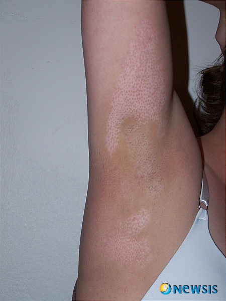 【서울=뉴시스】이재훈 기자 = 백반증은 발병원인이 규명이 되지 않은 피부과 질병 중 하나다. <관련기사 있음>&nbsp; realpaper7@newsis.com