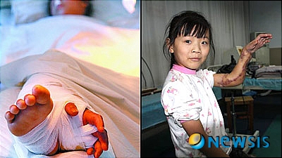 【서울=뉴시스】중국의 밍리라는 9살 소녀가 사고로 절단된 왼손을 3달 간 오른발에 임시로 이식했다 이를 다시 옮겨붙이는 수술에 성공했다. 사진은 오른발에 이식됐던 밍리의 왼손과 다시 왼팔에 옮겨진 후 밍리의 모습. <사진 출처 : 英 오렌지뉴스 닷컴 웹사이트>