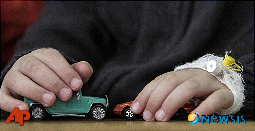 암덩어리, 알고보니 40여년 전에 삼킨 '장난감'