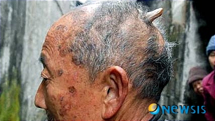 【서울=뉴시스】머리 윗부분에 약 7.5㎝ 크기의 뿔이 난 중국 지위안에 사는 황위안판 할아버지(84). <사진 출처 : 미 AOL 뉴스닷컴 웹사이트>