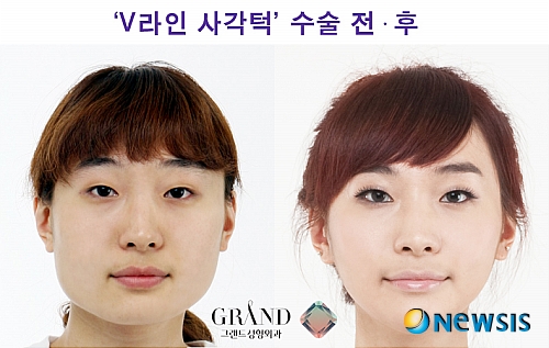 【서울=뉴시스】온라인뉴스팀 = 12일 숏커트와 단발머리를 잘 어울리게 하는 V라인 얼굴형을 찾아주는 방법에 대해 알아봤다. <사진=그랜드성형외과 제공> photo@newsis.com