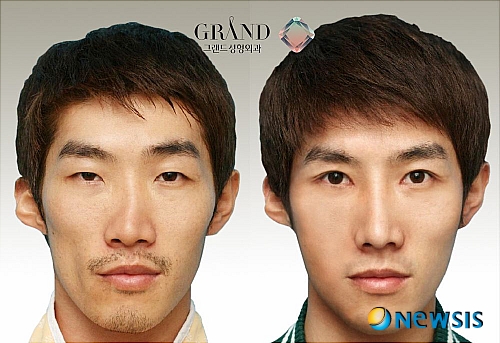 【서울=뉴시스】온라인뉴스팀 = 최근 강남, 압구정 인근에 위치한 성형외과에서는 코재수술을 받는 환자들이 간혹 생겨나고 있다. <사진=그랜드성형외과 제공> photo@newsis.com
