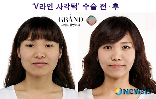 【서울=뉴시스】온라인뉴스팀 = 얼굴 라인과 턱 선이 둔한 외모는 하관이 처져 보이면서 넓어 보이는 느낌이 강해 한층 나이 들어 보이게 한다. <사진=그랜드성형외과 제공> photo@newsis.com 