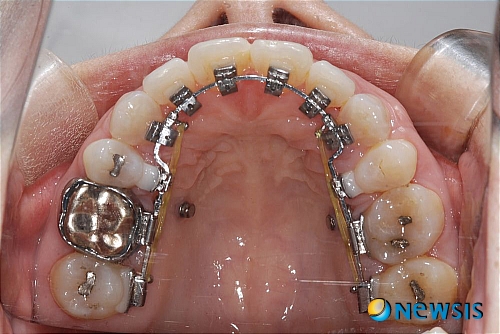 【서울=뉴시스】온라인뉴스팀 = 최근 '철도'를 연상케 했던 기존의 금속교정 장치가 아닌 눈에 띄지 않고 자연스러운 설측교정을 찾는 사람들이 많아지고 있다. <사진=에버스마일치과 제공> photo@newsis.com 