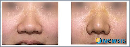 【서울=뉴시스헬스/뉴시스】 외모가 경쟁력이 되는 사회를 살면서 복코는 사회생활에 좋지 않은 영향을 줄 수 있으며, 당사자에게는 쉽게 해결할 수 없는 콤플렉스가 될 수 있다. <사진=차이정성형외과 제공> photo@newsis.com