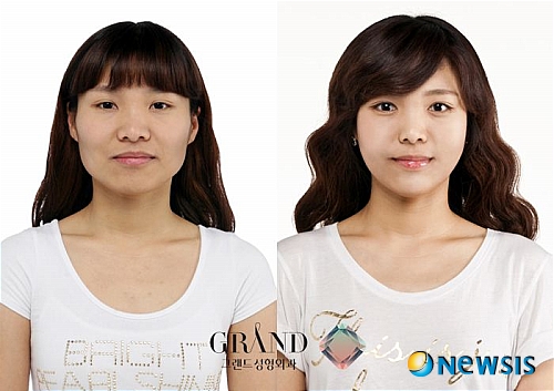 【서울=뉴시스】온라인뉴스팀 = 최근 서울을 비롯하여 대전, 대구, 부산 등에서는 여자뿐만 아니라 남자들도 사각턱과 같은 안면 윤곽을 개선하기 위해 성형외과를 찾는 사람들이 늘고 있는 추세다. <사진=그랜드성형외과 제공> photo@newsis.com