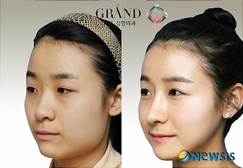 【서울=뉴시스】온라인뉴스팀 = 숏커트와 단발머리를 잘 어울리게 하는 V라인 얼굴을 찾아주는 방법에 대해 알아봤다. <사진=그랜드성형외과 제공> photo@newsis.com 