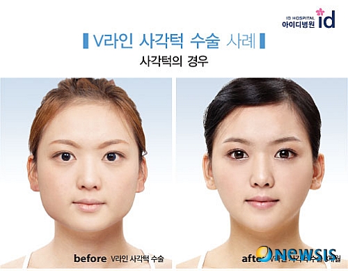 【서울=뉴시스】온라인뉴스팀 = 사각턱을 가진 사람들은 얼굴형 자체에 콤플렉스를 가진 경우가 많아 대개 긴 머리카락으로 턱을 가리곤 한다. <사진=아이디병원 제공> photo@newsis.com