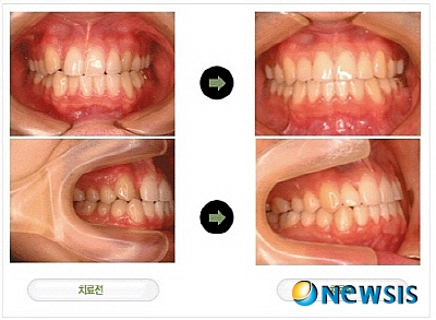 【서울=뉴시스】유희연 기자 = 설측교정 치료 전과 치료 후 치아 교정 비교.(사진=초이스치과 제공) photo@newsis.com