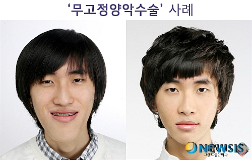 【서울=뉴시스】온라인뉴스팀 = 최근 '베이비페이스'라 불리며 주목받고 있는 '동안'의 안면윤곽 특징은 얼굴 앞쪽에 볼륨감이 살아있는 입체적인 얼굴라인이라 할 수 있다. <사진=그랜드성형외과 제공> photo@newsis.com