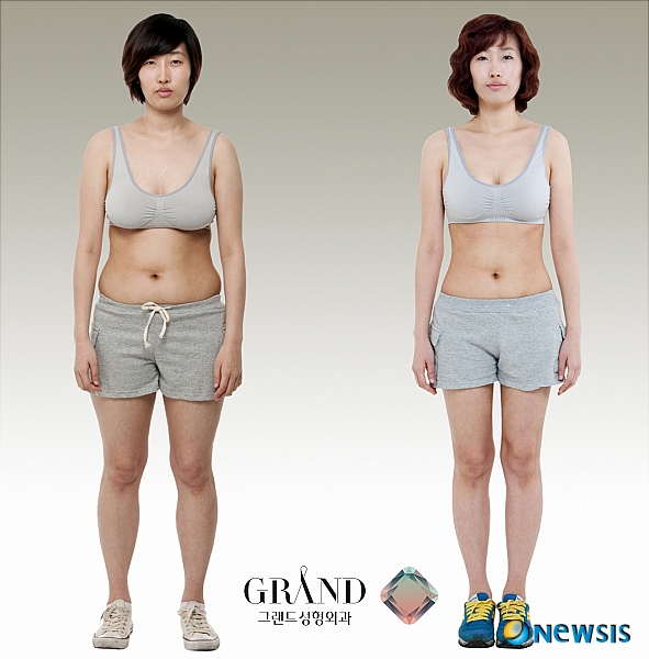 【서울=뉴시스】온라인뉴스팀 = 요즘은 직장인이나 일반 주부들도 지방흡입 전문병원이나 잘하는 곳에서 지방흡입 수술을 받는 등 그 열기가 뜨겁다. <사진=그랜드성형외과 제공> photo@newsis.com