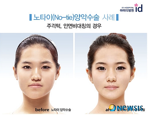 【서울=뉴시스】온라인뉴스팀 = 아이디병원은 환자의 안전과 편의를 개선하고자 악간고정 절차를 없앤 '노타이 양악수술'을 실시해 환자들에게 좋은 반응을 얻고 있다. <사진=아이디병원 제공> photo@newsis.com 