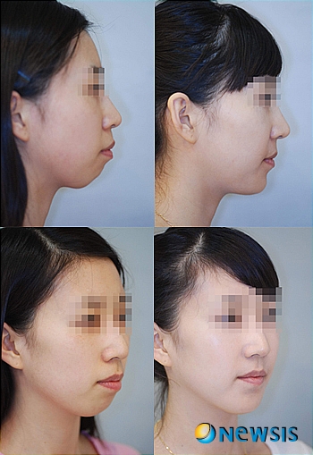 【서울=뉴시스】온라인뉴스팀 = 잘못 처방된 돌출입·양악수술은 심각한 부작용 초래할 수 있어 주의가 필요하다. <사진=오렌지성형외과/치과 제공> photo@newsis.com
