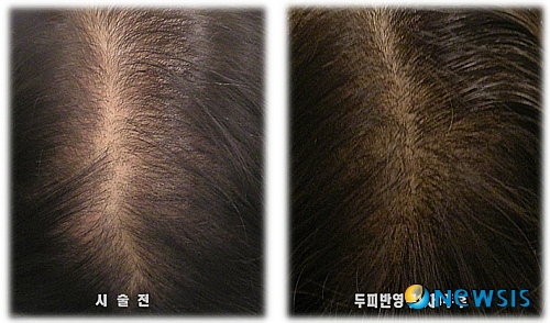 【서울=뉴시스】유희연 기자 = 신촌 연세미다인 모발이식전문병원은 착시현상을 일으키는 두피반영구화장을 통해 모발을 보다 풍성하게 연출시킬 수 있다고 전했다.(사진=연세미다인 제공)&nbsp; photo@newsis.com