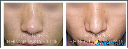 【서울=뉴시스】유희연 기자 = 코가 휘어지면서 발생하는 코 구조의 변형은 코 기능의 문제를 가져올 수 있다.(사진=차이정성형외과 제공)&nbsp; photo@newsis.com