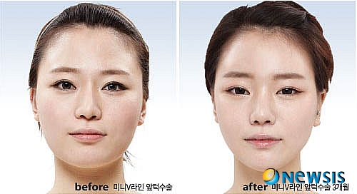 【서울=뉴시스】온라인뉴스팀 = 최근 미니V라인 앞턱수술이 등장해 앞턱이 콤플렉스인 사람들에게 인기를 끌고 있다. <사진=아이디병원 제공> photo@newsis.com 