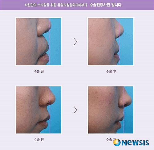 【서울=뉴시스】온라인뉴스팀 = 고양이수술의 경우 심하게 돌출된 경우가 아니라면 간단한 보형물을 이용해 고양이수술을 받으면 입이 들어가 보이게 되고 웃을 때 잇몸이 많이 보이는 이들은 잇몸을 덜 보이게 하는 효과가 있다. <사진=쥬얼리성형외과 제공> photo@newsis.com 