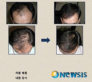 【서울=뉴시스】온라인뉴스팀 = 탈모로 고생하는 이들이 모발전문 클리닉이나 전문병원을 찾으면 금연과 금주를 권장하게 된다. <사진=모리치피부과 제공> photo@newsis.com 