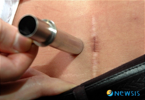 강릉 의원 허리 시술 감염 등 이상자 18명으로 늘어