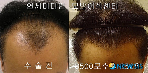 【서울=뉴시스】유희연 기자 = 모발이식전문 병원 연세미다인은 “M자탈모 모발이식후에는 꾸준한 탈모치료를 병행해야 한다”고 조언한다.(사진=연세미다인 제공) photo@newsis.com