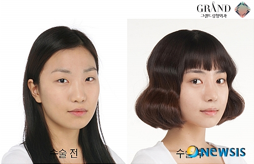 【서울=뉴시스】온라인뉴스팀 = 쌍꺼풀의 유무에 따라서 얼굴의 전체적인 인상이 크게 달라지는데 쌍꺼풀이 있으면 눈매가 크고 또렷해 보이며 시원한 인상을 가질 수 있다. <사진=그랜드성형외과 제공> photo@newsis.com