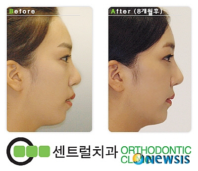 【서울=뉴시스】유희연 기자 = 센트럴치과가 단기간에 돌출입을 교정하는 ‘킬본 에이 포인트 돌출입교정’을 개발했다고 밝혔다.(사진=센트럴치과 제공) photo@newsis.com