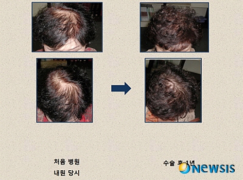 【서울=뉴시스】온라인뉴스팀 = 최근 20~30대 탈모환자가 늘어나고 있으며 남성에게서만 나타나는 탈모가 점차적으로 여성에게도 확대되고 있다. <사진=모리치피부과 제공> photo@newsis.com 