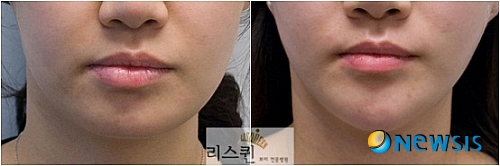【서울=뉴시스】온라인뉴스팀 = 삶의 질이 향상되고 미에 대한 여성들의 관심이 높아지면서 얼굴 라인을 전체적으로 교정하는 성형외과적 시술의 인기가 높다. <사진=리스퀸 클리닉 제공> photo@newsis.com 