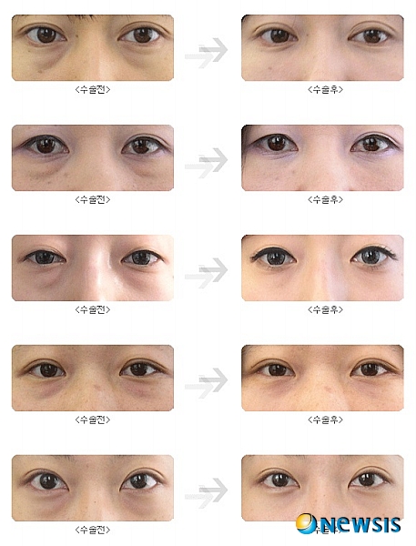 【서울=뉴시스】유희연 기자 = 눈밑지방 수술 후에는 눈밑애교살이 살아나는 보너스 효과를 볼 수 있다.(사진=차이정성형외과 제공) photo@newsis.com
