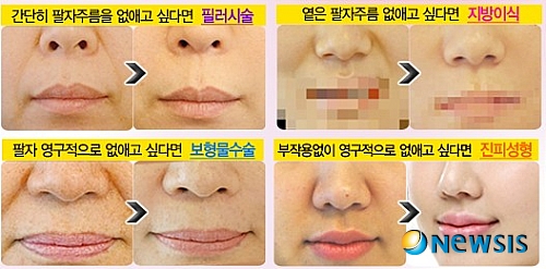 【서울=뉴시스】유희연 기자 = 코성형과 팔자주름 개선을 위해서는 유형에 맞는 시술이 중요하다.(사진=리앤장성형외과 제공)&nbsp; photo@newsis.com