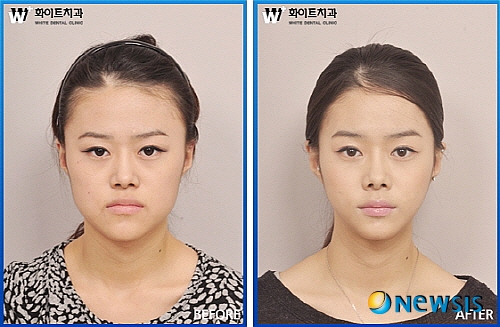 【서울=뉴시스】유희연 기자 = 화이트치과에서 양악수술을 받은 환자의 전, 후 사진.(사진=화이트치과 제공) photo@newsis.com