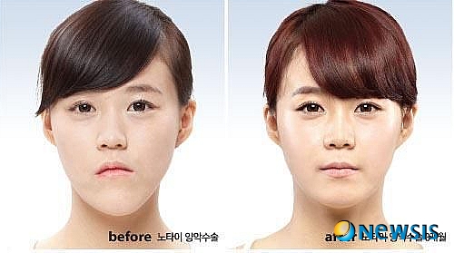 【서울=뉴시스헬스/뉴시스】 아이디병원 노타이 양악수술 전후 사례. <사진=아이디병원 제공> 조진성기자 cjs@newsishealth.com