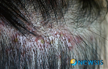 【서울=뉴시스】유희연 기자 = 젊은 남성들에게 잘 나타나는 모낭염.(사진=베스킨한의원 제공)&nbsp; photo@newsis.com