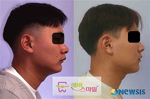 【서울=뉴시스】온라인뉴스팀 = 무턱치아교정 전후 사례. <사진=에버스마일치과 제공> photo@newsis.com