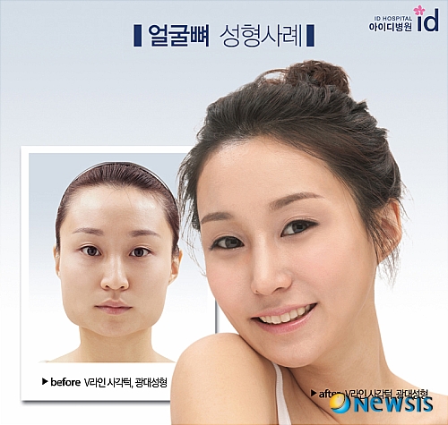 【서울=뉴시스】온라인뉴스팀 = 동안광대수술 전후 사례. <사진=아이디병원 제공> photo@newsis.com