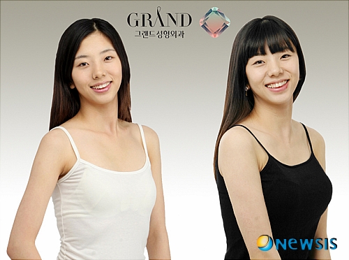 【서울=뉴시스】온라인뉴스팀 = 가슴성형 전후 사례. <사진=그랜드성형외과 제공> photo@newsis.com