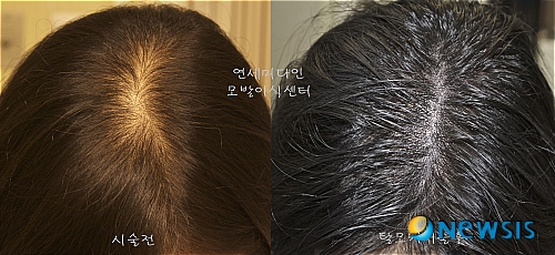 【서울=뉴시스】유희연 기자 = 두피가 비어보이는 탈모증상에 모발이식과 더불어 탈모커버술에 대한 관심이 높아지고 있다.(사진=연세미다인 제공) photo@newsis.com