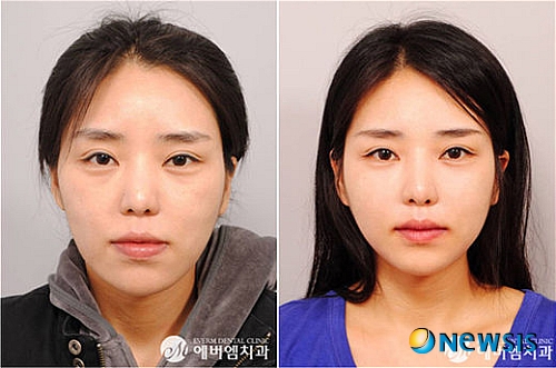 【서울=뉴시스】온라인뉴스팀 = 양악수술 전후 사례. <사진=에버엠치과 제공> photo@newsis.com