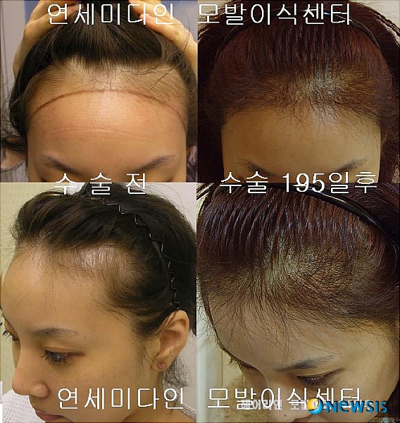 【서울=뉴시스】유희연 기자 = 연세미다인에 의하면 헤어라인에 따라 얼굴의 크기가 좌우될 수 있다.(사진=연세미다인 제공) photo@newsis.com