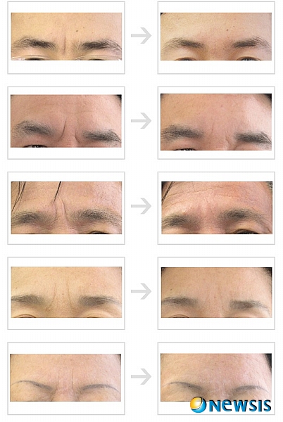 【서울=뉴시스】유희연 기자 = 양측 눈썹사이인 미간의 주름 개선을 통해 동안의 피부를 가꿀 수 있다.(사진=차이정성형외과 제공)&nbsp;&nbsp; photo@newsis.com