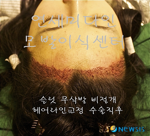 【서울=뉴시스】유희연 기자 = M자 헤어라인교정 후 생착률이 높이는 게 중요하다.(사진=연세미다인 제공)&nbsp; photo@newsis.com