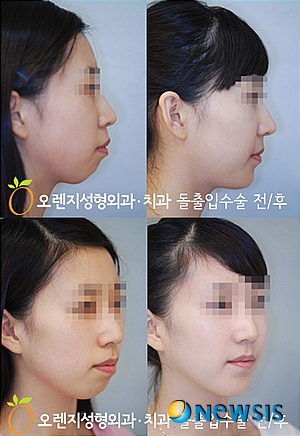 【서울=뉴시스】온라인뉴스팀 = 돌출입수술 전후 사례. (사진=오렌지성형외과 제공) photo@newsis.com