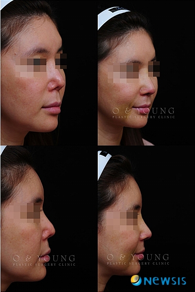 【서울=뉴시스】유희연 기자 = 오앤영성형외과가 줄기세포치료법을 도입해 코재수술 시기 앞당기고 있다.(사진=오앤영성형외과 제공)&nbsp;&nbsp; photo@newsis.com