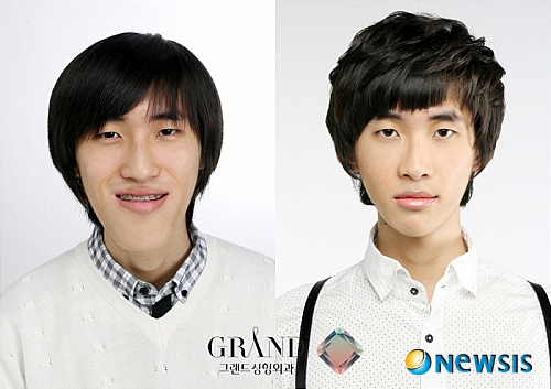 【서울=뉴시스】온라인뉴스팀 = 양악수술 전후 사례. (사진=그랜드성형외과 제공) photo@newsis.com