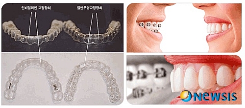 【서울=뉴시스】온라인뉴스팀 = 인비절라인은 보이지 않게 치아를 가지런히 만들어줄 뿐만 아니라 구강건강에도 큰 도움을 준다. (사진=에버스마일치과 제공) photo@newsis.com