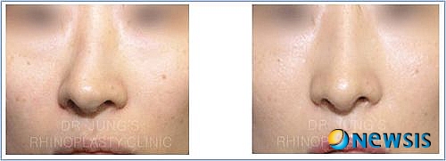 【서울=뉴시스헬스/뉴시스】 휜코 수술 전후 사례. (사진=차이정성형외과 제공) 조진성기자 cjs@newsishealth.com