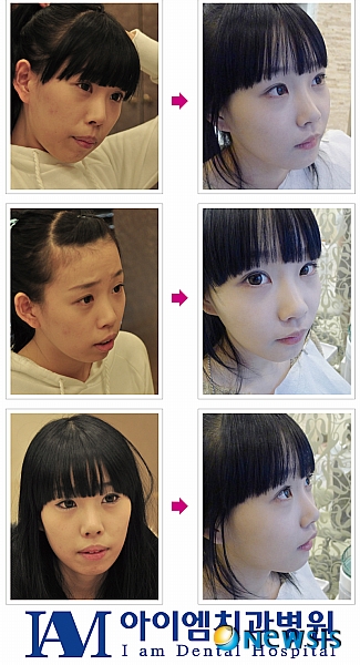 【서울=뉴시스】온라인뉴스팀 = 가상성형 사례. (사진=아이엠치과 제공)&nbsp; photo@newsis.com
