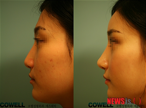 【서울=뉴시스】온라인뉴스팀 = '더블라인' 성형 전후 사례. (사진=코웰성형외과 제공)&nbsp; photo@newsis.com