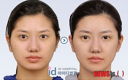 【서울=뉴시스헬스/뉴시스】 아이디병원의 '미니V라인 앞턱수술' 전후 사례. (사진=아이디병원 제공) 조진성기자 cjs@newsishealth.com